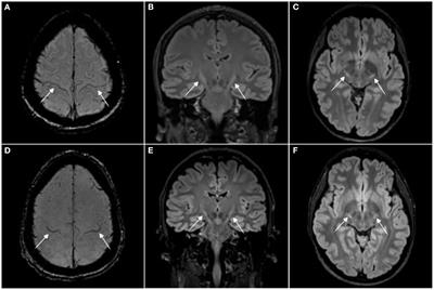 Neuroimaging findings in preclinical amyotrophic lateral sclerosis models—How well do they mimic the clinical phenotype? A systematic review